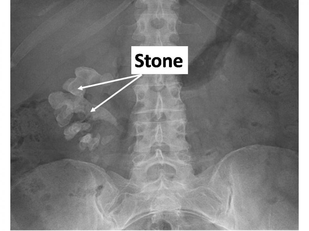 Kidney Stone