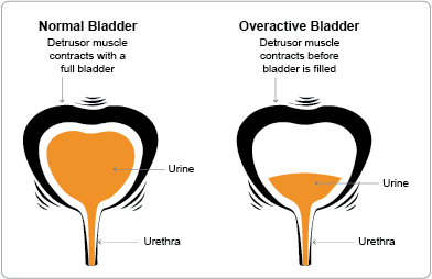 Overactive Bladder