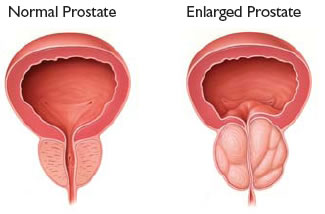 Prostate BPH