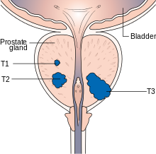 Prostate Cancer